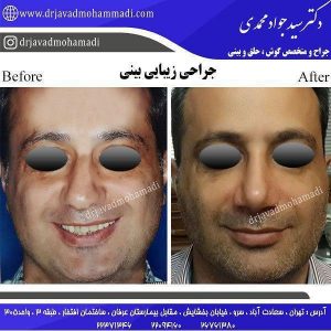 جراحی بینی در مردان